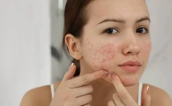 How to Care for Acne-Prone Skin: A Comprehensive Guide 2023