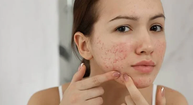 How to Care for Acne-Prone Skin: A Comprehensive Guide 2023